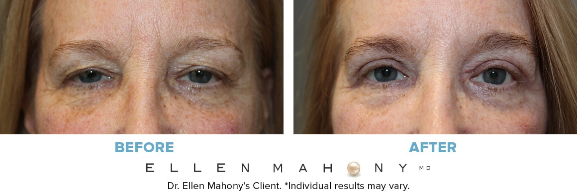 Before and After Image: Case #11566 - front