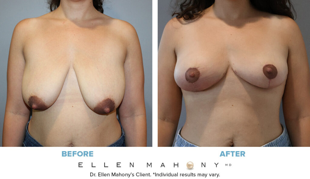 Before and After Image: Case #12761 - front