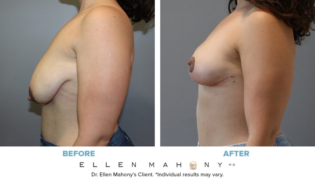 Before and After Image: Case #12761 - left-side