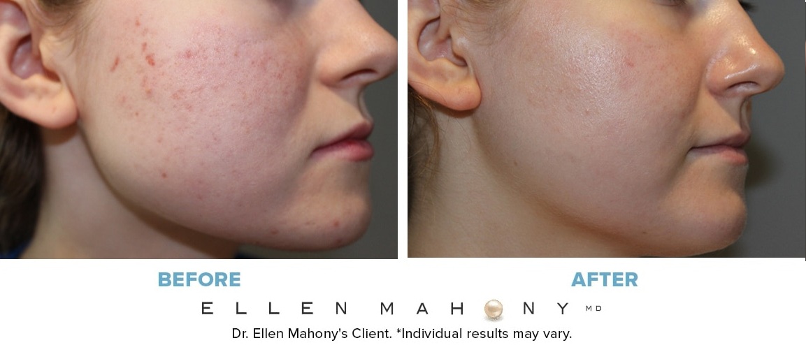 Before and After Image: Case #13130 - right-side
