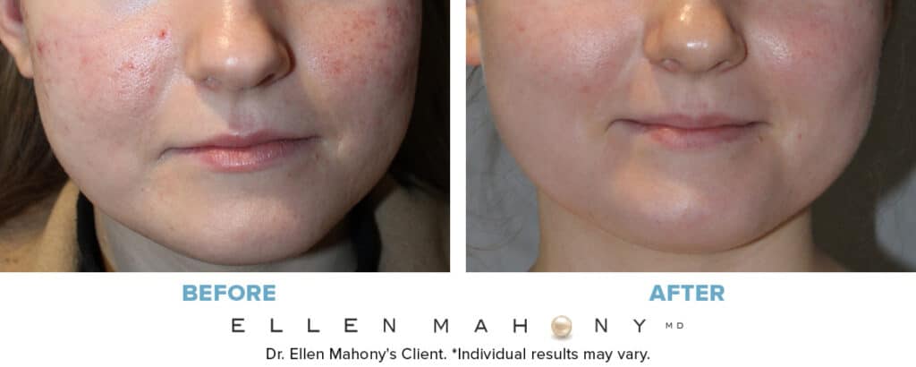 Before and After Image: Case #13130 - front