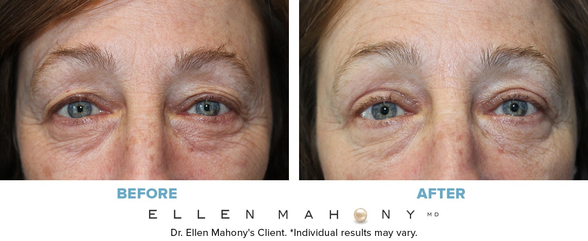 Before and After Image: Case #14435 - front