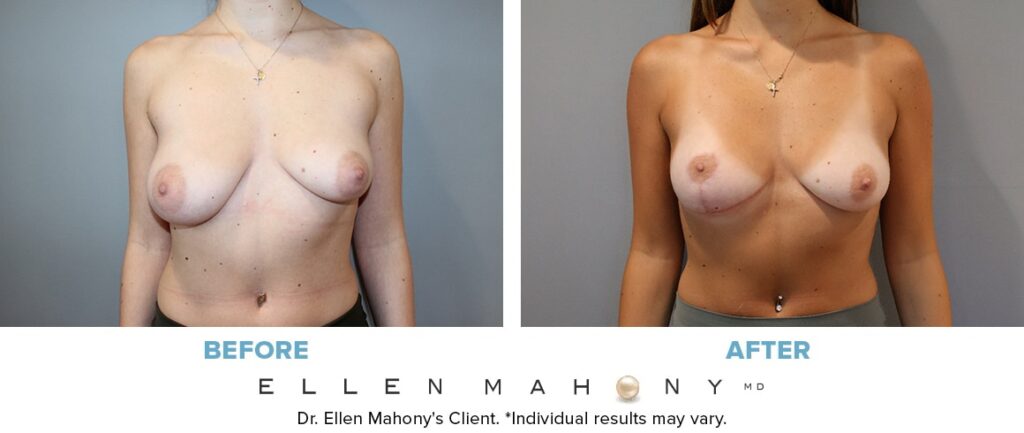 Before and After Image: Case #14436 - front