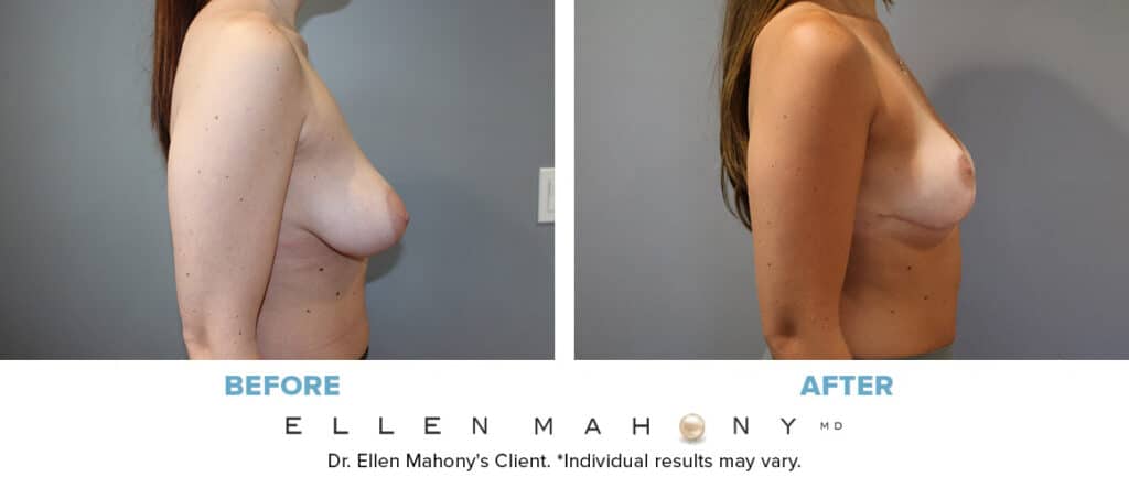 Before and After Image: Case #14436 - right-side