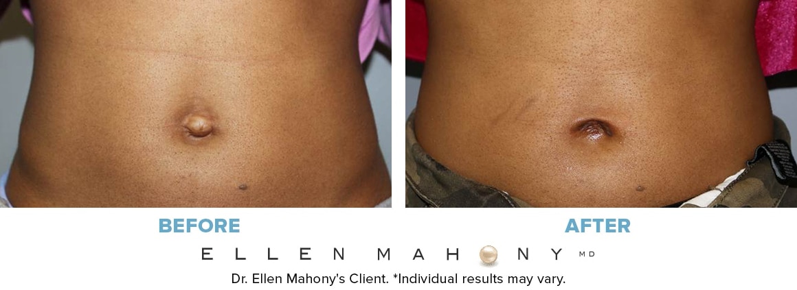Before and After Image: Case #14518 - front