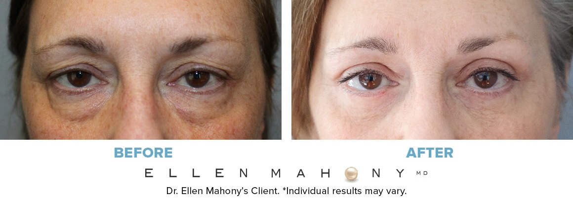 Before and After Image: Case #14562 - front