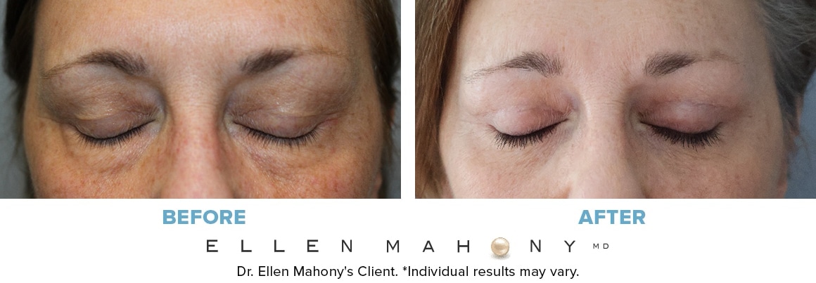 Before and After Image: Case #14562 - front