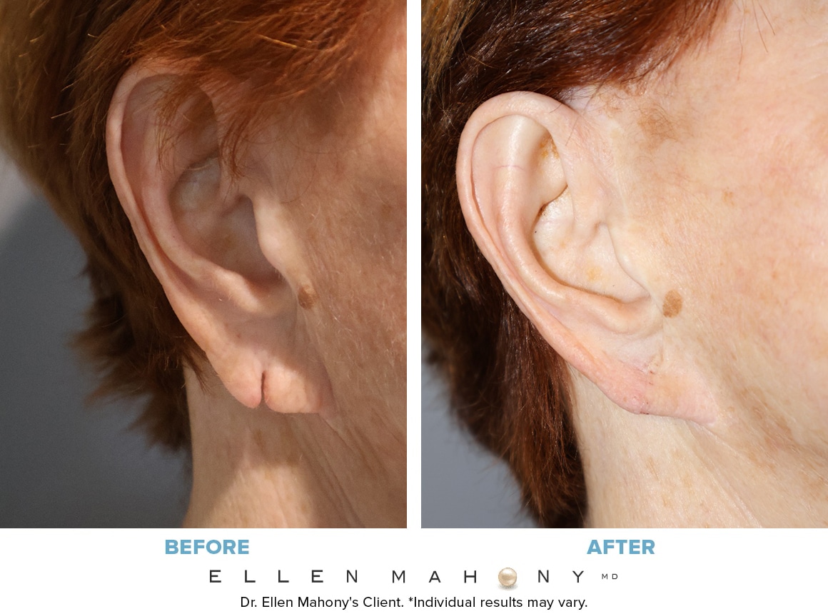 Before and After Image: Case #8855 - right-side