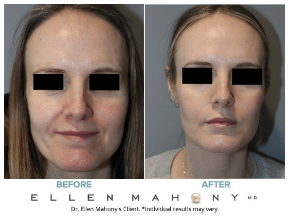 Before and After Image: Case #13061 - front