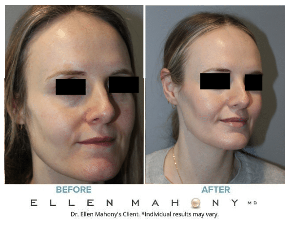 Before and After Image: Case #13061 - right-front-oblique