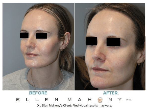 Before and After Image: Case #13061 - left-front-oblique
