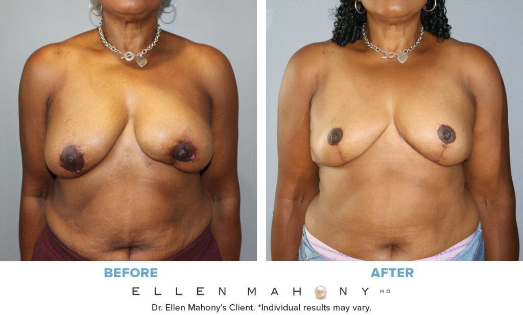 Before and After Image: Case #14029 - front