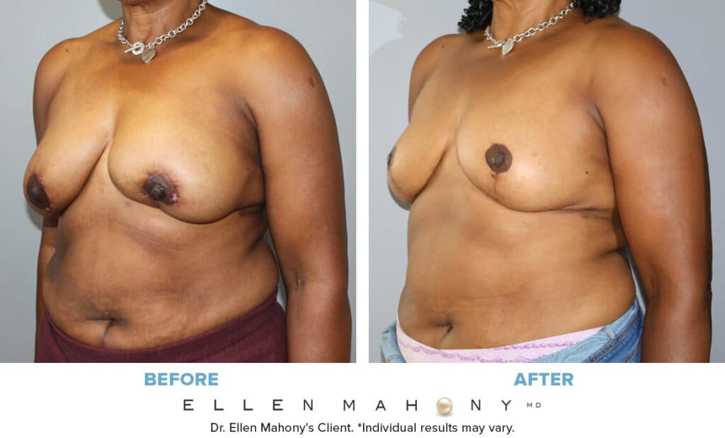 Before and After Image: Case #14029 - left-front-oblique