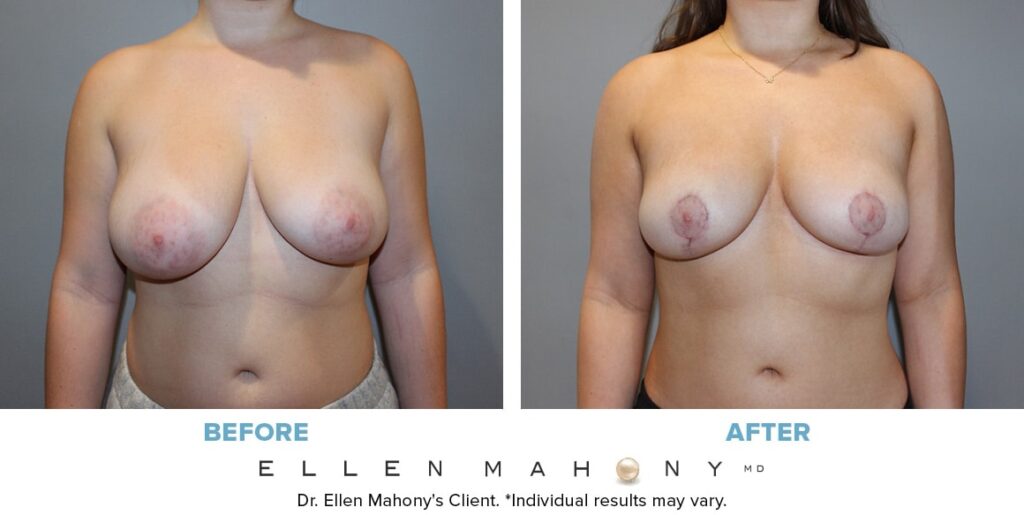 Before and After Image: Case #14044 - front