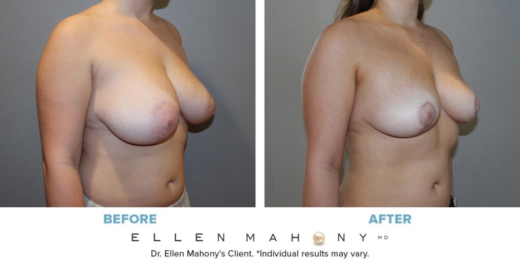 Before and After Image: Case #14044 - right-front-oblique
