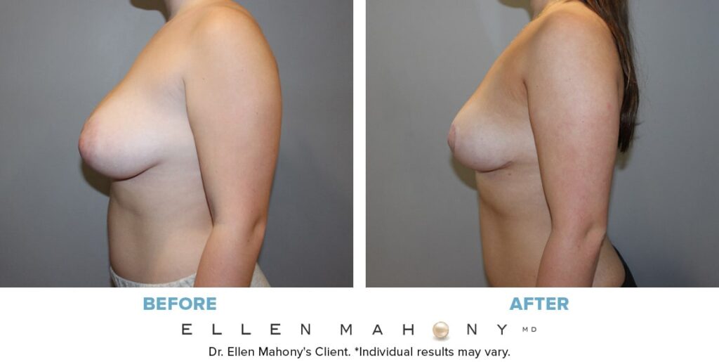 Before and After Image: Case #14044 - left-side
