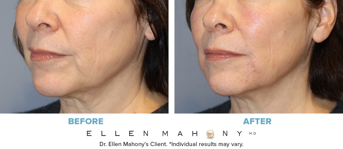 Before and After Image: Case #15014 - left-front-oblique