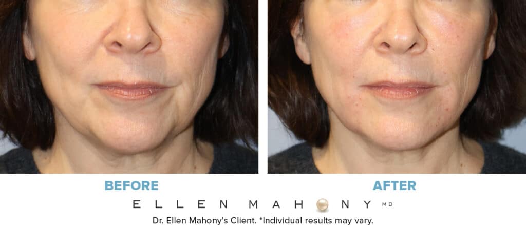Before and After Image: Case #15014 - front