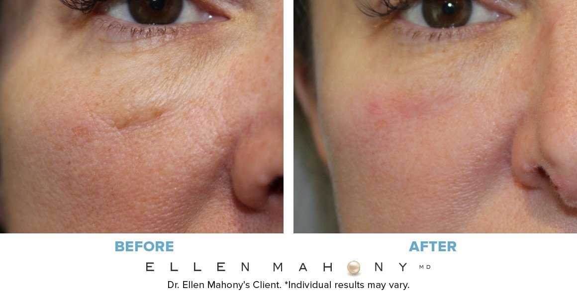 Before and After Image: Case #13358 - front