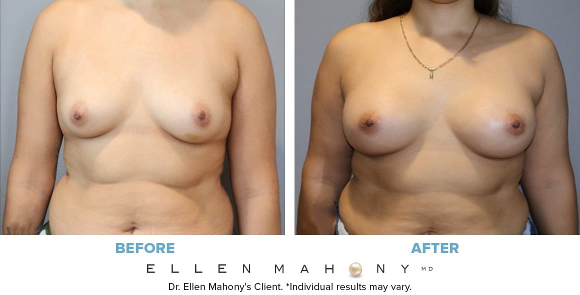 Before and After Image: Case #14769 - front