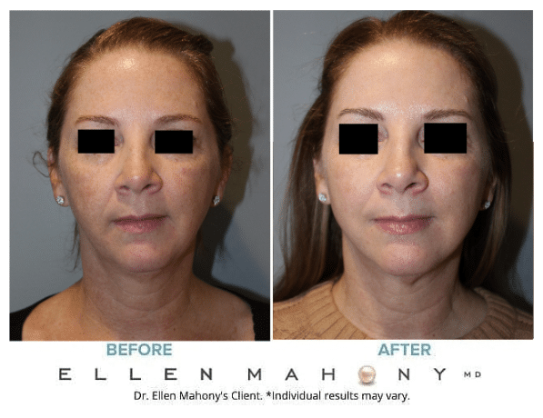 Before and After Image: Case #13940 - front