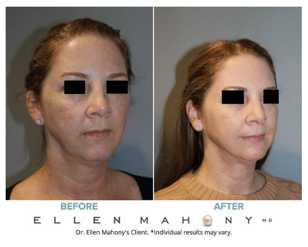 Before and After Image: Case #13940 - right-front-oblique