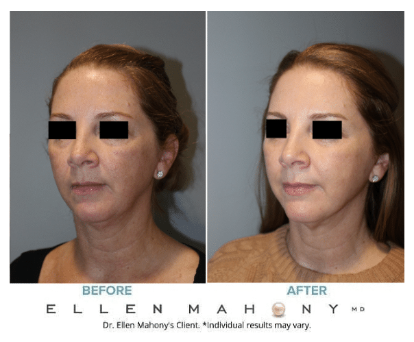 Before and After Image: Case #13940 - left-front-oblique