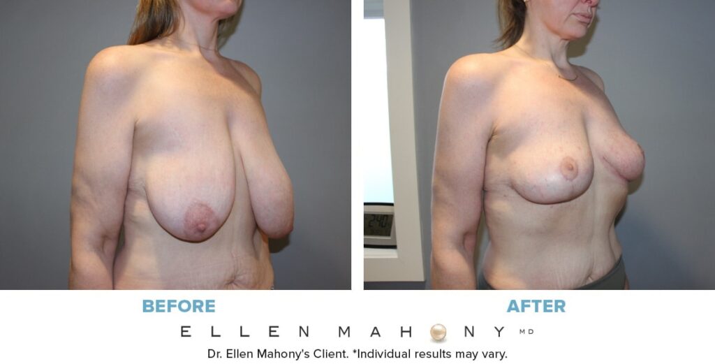 Before and After Image: Case #14057 - right-front-oblique