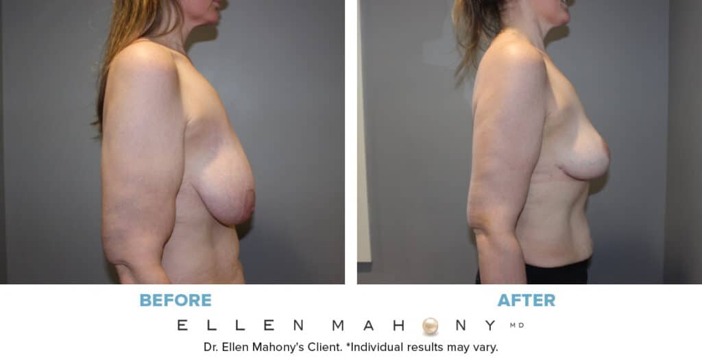 Before and After Image: Case #14057 - right-side