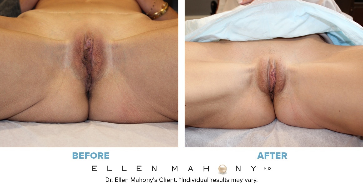 Before and After Image: Case #14079 - front