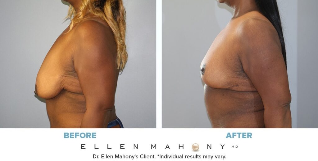 Before and After Image: Case #14589 - left-side
