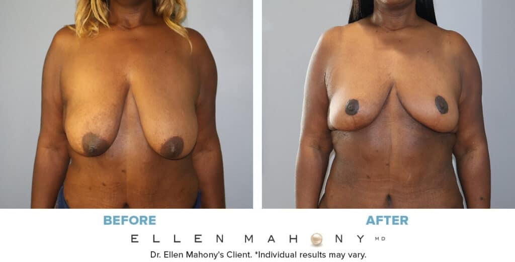 Before and After Image: Case #14589 - front