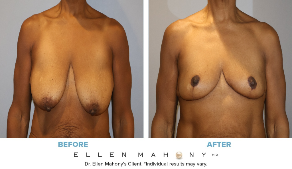 Before and After Image: Case #14988 - front