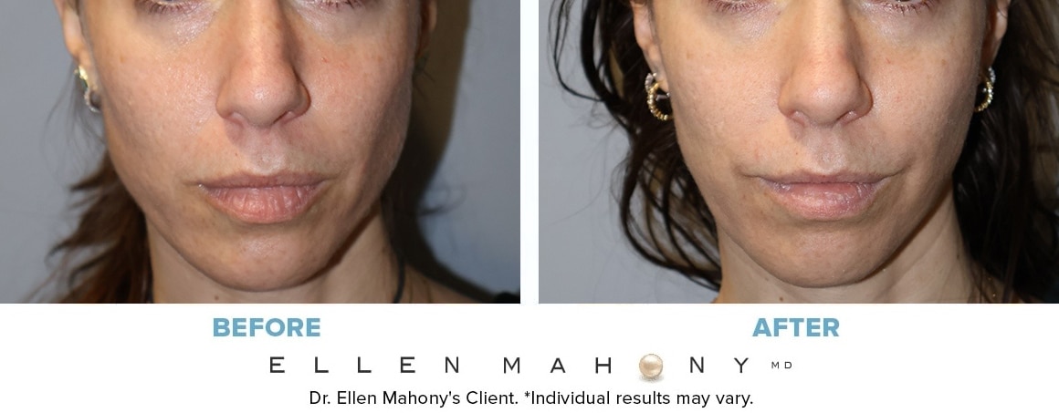 Before and After Image: Case #14991 - front