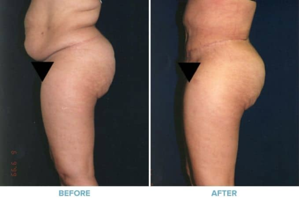Body Lift in Westport, CT