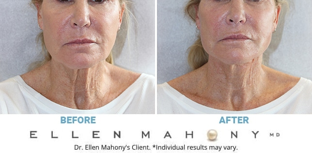 Before and After Image: Case #2812 - front