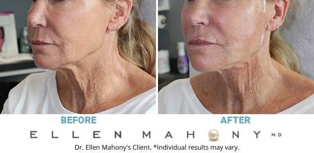 Before and After Image: Case #2812 - front