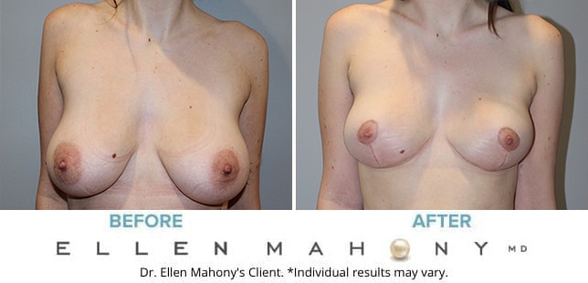 Before and After Image: Case #10419 - front