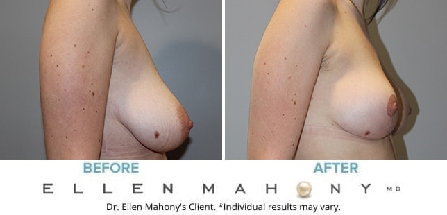 Before and After Image: Case #10419 - right-side