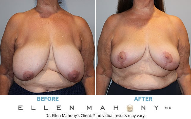 Before and After Image: Case #10799 - front