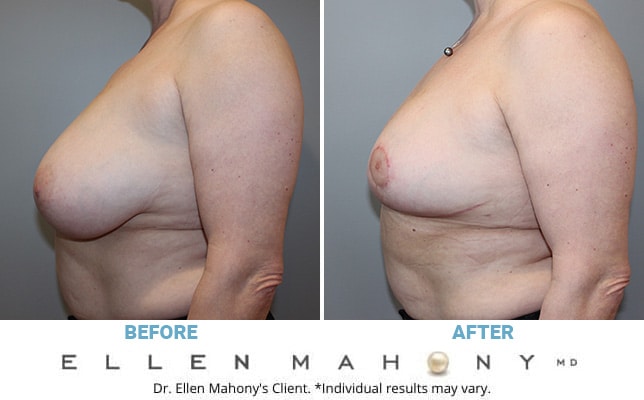 Before and After Image: Case #10377 - left-side