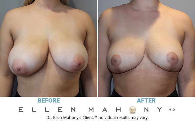 Before and After Image: Case #10794 - front