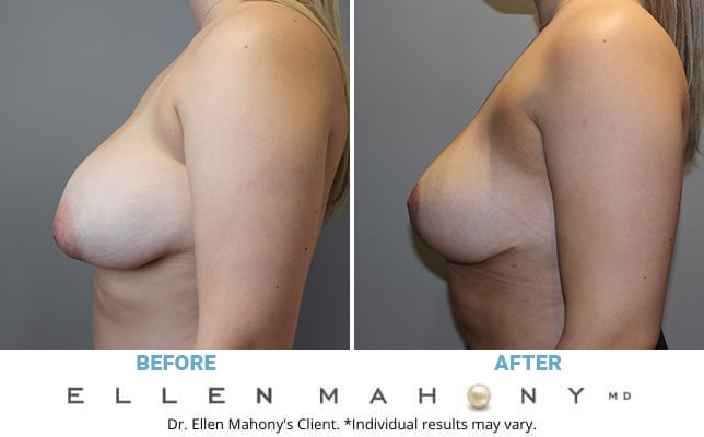 Before and After Image: Case #10794 - left-side