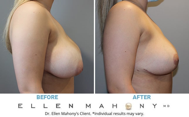 Before and After Image: Case #10794 - right-side