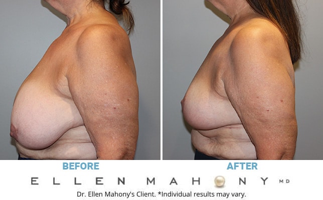 Before and After Image: Case #10799 - left-side