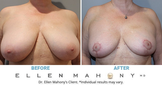 Before and After Image: Case #10377 - front