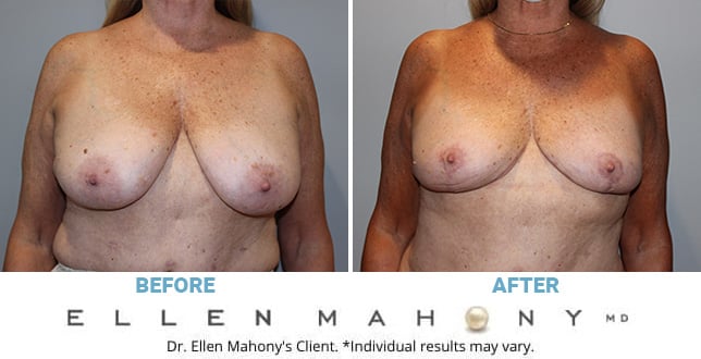 Before and After Image: Case #10781 - front