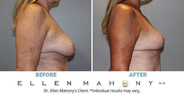 Before and After Image: Case #10781 - right-side