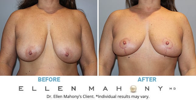 Before and After Image: Case #10601 - front