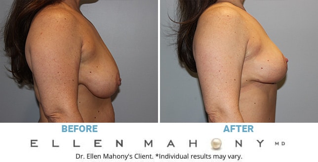 Before and After Image: Case #10601 - right-side